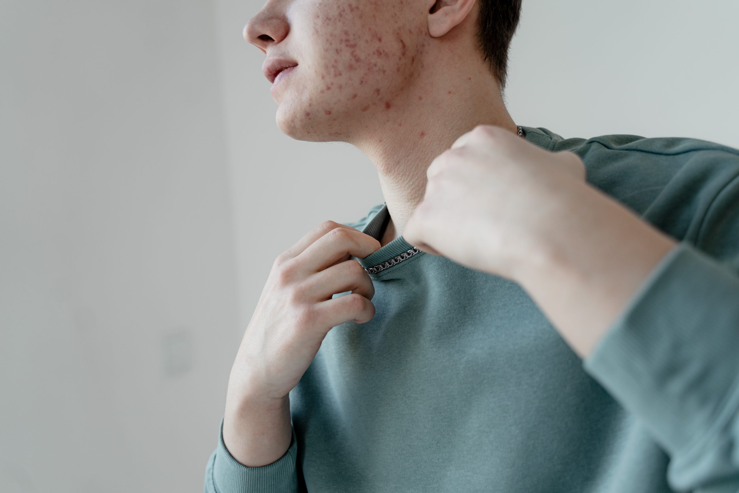 Acne and skin conditions