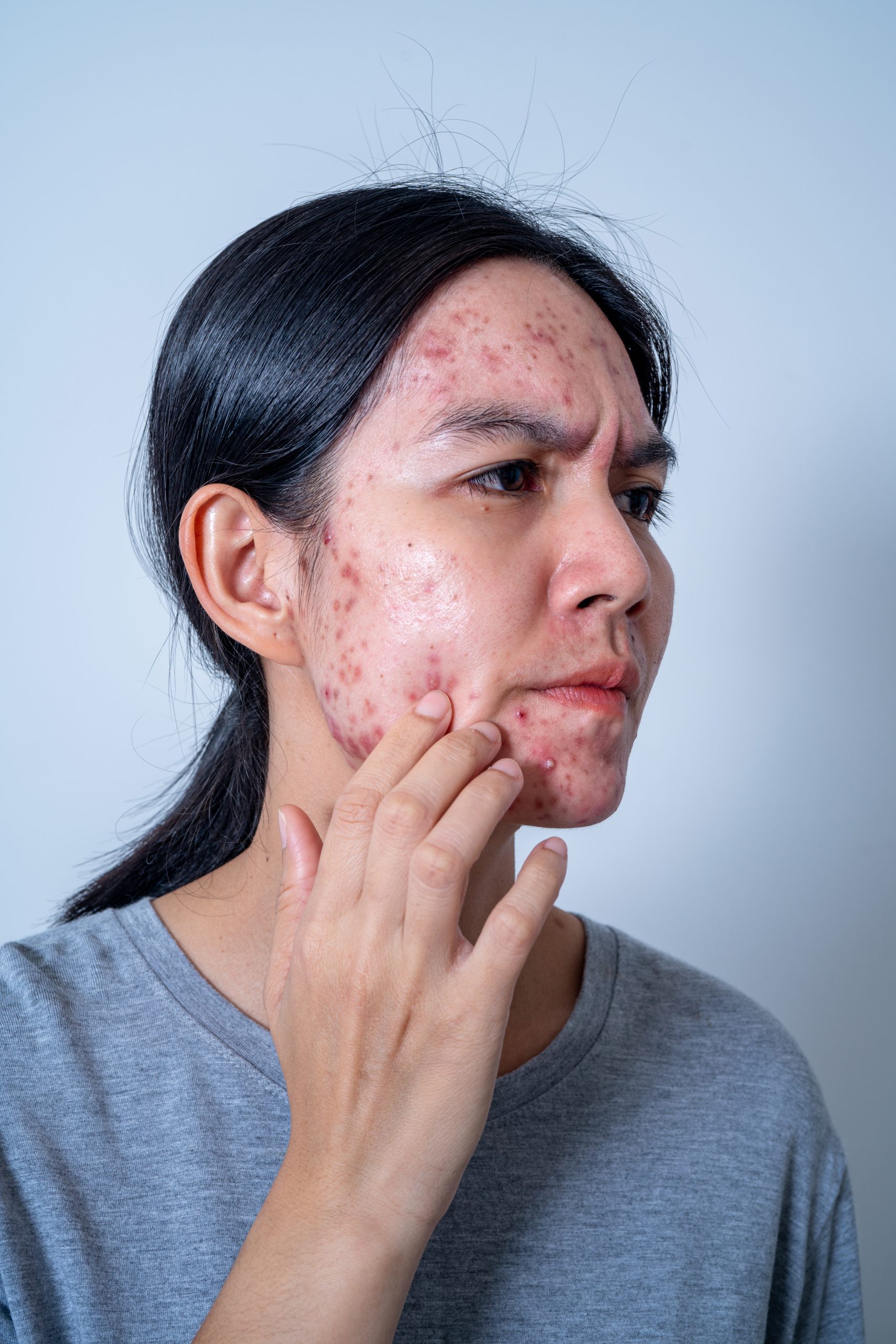 Acne and skin Conditions